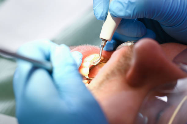 Best Emergency Tooth Extraction in Swartz Creek, MI